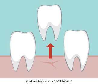 A removal of the molar by the dentist in the dental clinic. Flat vector stock illustration with medical tooth extraction concept.