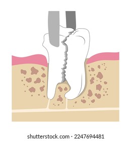 La eliminación del diente molar se estrelló en la mandíbula. Extracción quirúrgica de un diente roto. Ilustración médica de estilo plano.