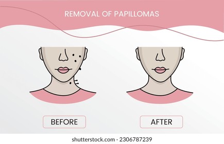 Removal of papillomas, laser cosmetology before procedure and after applying treatment in vector. Illustration of a woman with smooth clean skin and problematic skin.