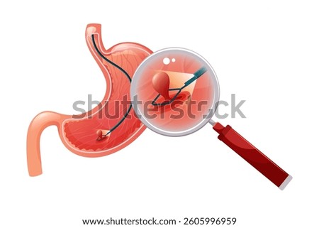 Removal polyp in stomach. Enlarged view of endoscope grasping polyp with loop. Vector medical illustration.