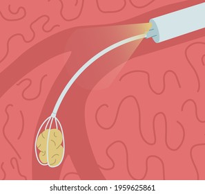 Removal of a stone from the salivary gland duct. Sialendoscopy vector illustration.