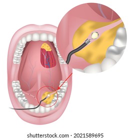 Removal of stones of the salivary glands using an endoscope. Sialoendoscope. Vector illustration