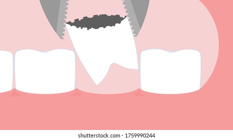 Extracción de una ilustración vectorial de cirugía dental