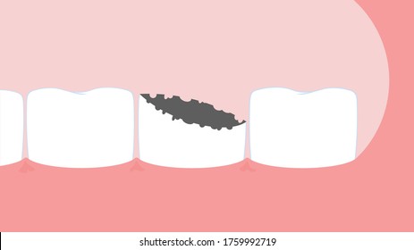 Removal of a tooth surgery vector illustration