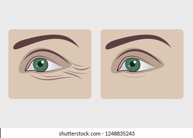Removal of wrinkles under eyes, blephoroplasty of lower eyelids, rejuvenation of skin under eyes, filling facial wrinkles. Vector illustration before and after