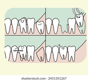 extirpar las muelas del juicio y la cirugía de replantación de las muelas del juicio - ilustración plana 