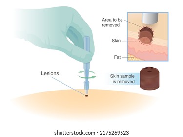 Removed a sample of skin with the Biopsy punches tool. Cut small tissue of the patient for for diagnosis and skin cancer treatment.