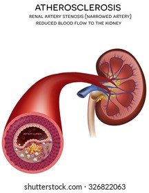 Renal Artery Disease. Atherosclerosis Progression At The End Blocked Blood Flow.