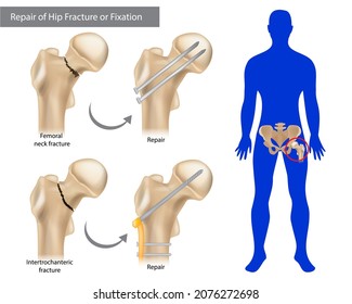 Repair of Hip Fracture or Fixation. Intertrochanteric fracture or Femoral neck fracture. Broken Hip svg