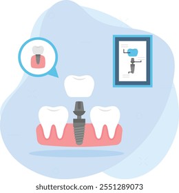 Reemplazo de un diente perdido usando el concepto de implante dental, reemplazo permanente de dentaduras fijas, diseño de ícono de color de Vector, símbolo de odontología, signo de atención médica, instrumento dental