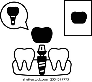 Replacing one Missing Teeth using Dental Implant Concept, permanent fixed dentures replacement vector outline design, Odontology symbol, manual dexterity sign Dentist tools stock illustration