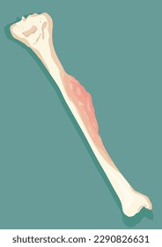 Representation of bone cancer - vector illustration