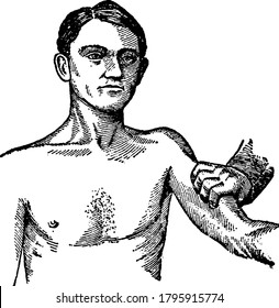 Represents branchial compression, in bleeding from any part of the arm, the branchial artery should be pressed outwards against the bone just behind the inner border of the larger muscle of the arm