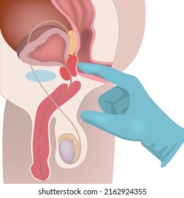 Reproductive System Of A Man. Palpation And Massage Of The Prostate. Diagram With Internal Organs. Medical Poster. Vector Illustration
