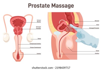 Reproductive System Of A Man. Palpation And Massage Of The Prostate. Prostatitis Prevention And Treatment. Male Pelvic Floor Internal Organs. Medical Poster. Flat Vector Illustration