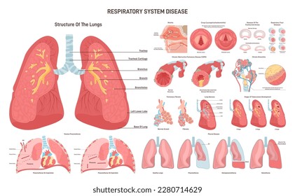 Respiratory tract diseases set. Inflammatory disease and pathological conditions of the airways. Cause of shortness of breath and cough. Medical education poster. Flat vector illustration