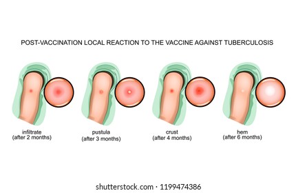 response to vaccination against tuberculosis