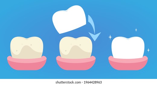 Restoration of a tooth, installation of a crown, installation dental veneers.