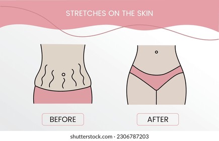 Resurfacing stretch marks on the skin, body with stretch marks on the abdomen. Laser cosmetology before procedure and after applying treatment in vector.