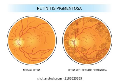 retinal degenerative and Blurry vision of Age related Blind spots with cone rod dystrophy svg