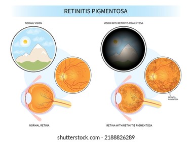retinal degenerative and Blurry vision of Age related Blind spots with cone rod dystrophy svg
