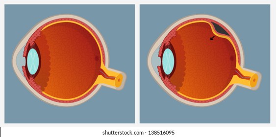 Retinal Detachment