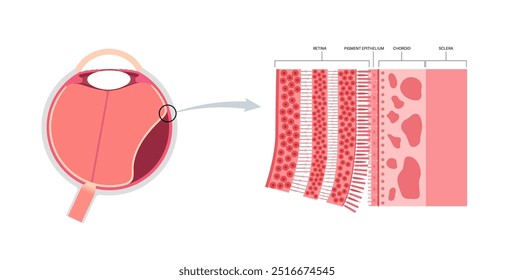 Cartaz anatômico do descolamento da retina. Conceito de doenças do olho humano, problema do tecido da retina. Perda de visão e cegueira, moscas volantes e flashes e escurecimento da visão lateral ilustração de vetor médico.