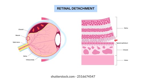 Cartaz anatômico do descolamento da retina. Conceito de doenças do olho humano, problema do tecido da retina. Perda de visão e cegueira, moscas volantes e flashes e escurecimento da visão lateral ilustração de vetor médico.