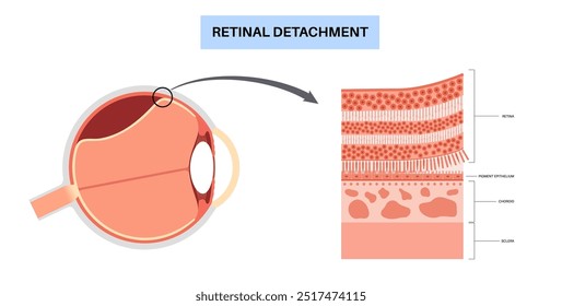 Cartaz anatômico do descolamento da retina. Conceito de doenças do olho humano, problema do tecido da retina. Perda de visão e cegueira, moscas volantes e flashes e escurecimento da visão lateral ilustração de vetor médico.