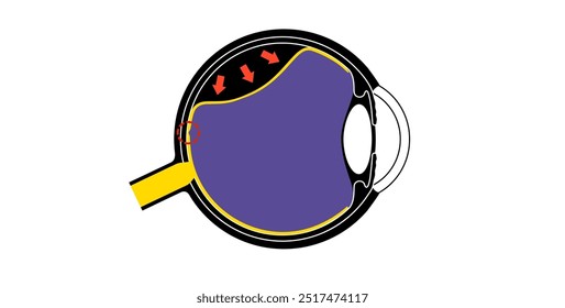 Cartaz anatômico do descolamento da retina. Conceito de doenças do olho humano, problema do tecido da retina. Perda de visão e cegueira, moscas volantes e flashes e escurecimento da visão lateral ilustração de vetor médico.