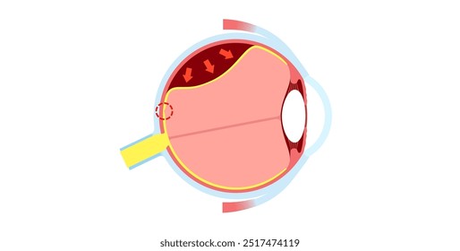 Cartaz anatômico do descolamento da retina. Conceito de doenças do olho humano, problema do tecido da retina. Perda de visão e cegueira, moscas volantes e flashes e escurecimento da visão lateral ilustração de vetor médico.