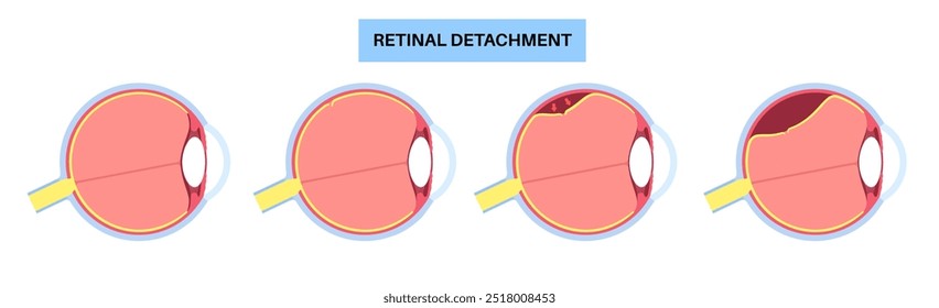 Cartaz anatômico do descolamento da retina. Conceito de doenças do olho humano, problema do tecido da retina. Perda de visão e cegueira, moscas volantes e flashes e escurecimento da visão lateral ilustração de vetor médico.