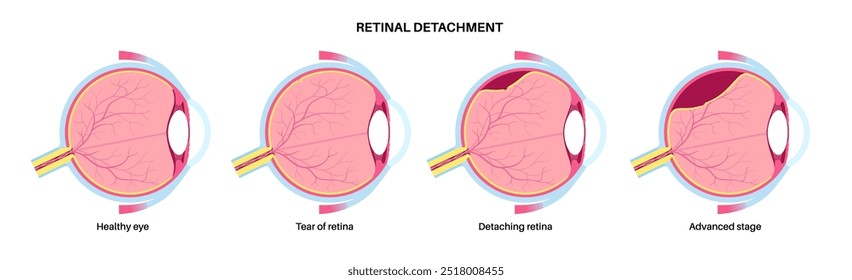 Retinal detachment anatomical poster. Human eye diseases concept, retina tissue problem. Vision loss and blindness, eye floaters and flashes and darkening side vision medical vector illustration.