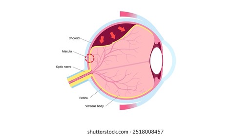 Cartaz anatômico do descolamento da retina. Conceito de doenças do olho humano, problema do tecido da retina. Perda de visão e cegueira, moscas volantes e flashes e escurecimento da visão lateral ilustração de vetor médico.