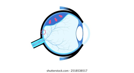 Cartaz anatômico do descolamento da retina. Conceito de doenças do olho humano, problema do tecido da retina. Perda de visão e cegueira, moscas volantes e flashes e escurecimento da visão lateral ilustração de vetor médico.