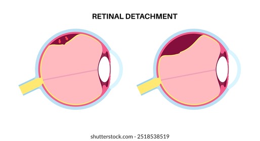 Cartaz anatômico do descolamento da retina. Conceito de doenças do olho humano, problema do tecido da retina. Perda de visão e cegueira, moscas volantes e flashes e escurecimento da visão lateral ilustração de vetor médico.