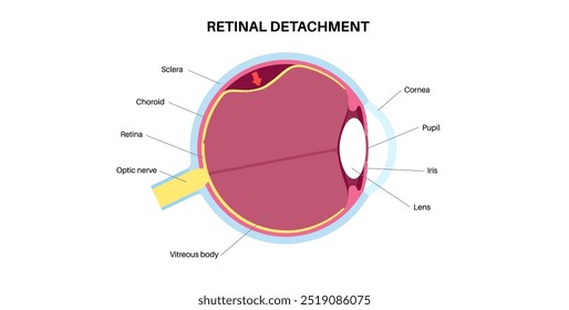 Cartaz anatômico do descolamento da retina. Conceito de doenças do olho humano, problema do tecido da retina. Perda de visão e cegueira, moscas volantes e flashes e escurecimento da visão lateral ilustração de vetor médico.