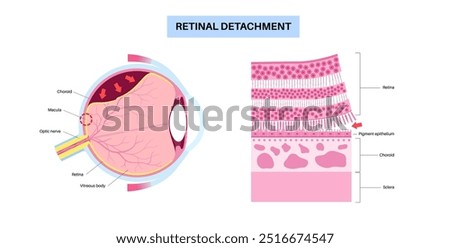 Retinal detachment anatomical poster. Human eye diseases concept, retina tissue problem. Vision loss and blindness, eye floaters and flashes and darkening side vision medical vector illustration.
