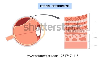 Retinal detachment anatomical poster. Human eye diseases concept, retina tissue problem. Vision loss and blindness, eye floaters and flashes and darkening side vision medical vector illustration.