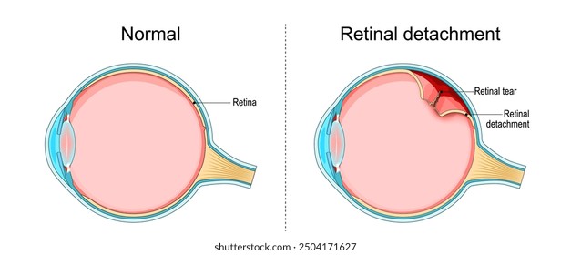 Retinal detachment. Cross section of a normal human eyes and disorder of the eye in which the retina peels. Schematic diagram. Detailed vector illustration