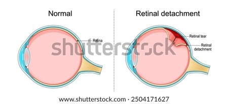 Retinal detachment. Cross section of a normal human eyes and disorder of the eye in which the retina peels. Schematic diagram. Detailed vector illustration