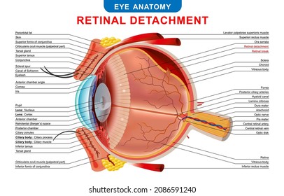 Retinal detachment. Eye condition: detachment of the retina from choroid.