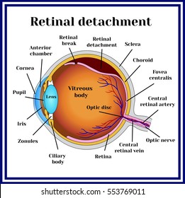 Retinal detachment. Detachment of the retina from choroid.