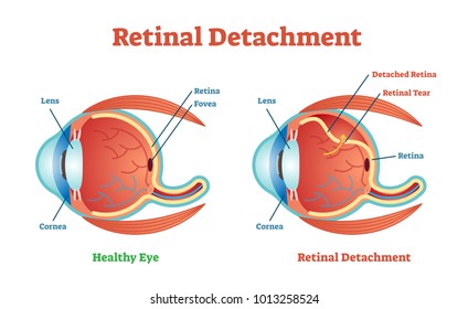 Diagrama de ilustração vetorial de descolamento de retina, esquema anatômico. Informações educacionais sobre medicamentos. 