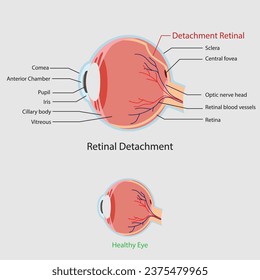 Vektorgrafik der Netzhautentfernung, anatomisches Schema. Medizin, Bildung, Cartoon-Stil, flach, isoliert weiß, Sehretina