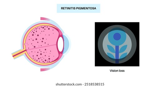 Retinitis pigmentosa anatomical poster. Human eye diseases concept, retina tissue problem. Vision loss and blindness, sensitivity to bright light and loss of color vision medical vector illustration.