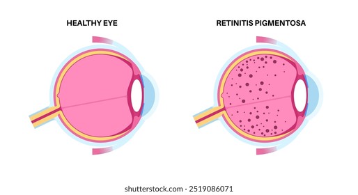 Cartaz anatômico da retinite pigmentosa. Conceito de doenças do olho humano, problema do tecido da retina. Perda de visão e cegueira, sensibilidade à luz brilhante e perda de visão de cor ilustração do vetor médico.