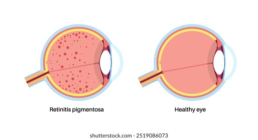 Cartaz anatômico da retinite pigmentosa. Conceito de doenças do olho humano, problema do tecido da retina. Perda de visão e cegueira, sensibilidade à luz brilhante e perda de visão de cor ilustração do vetor médico.