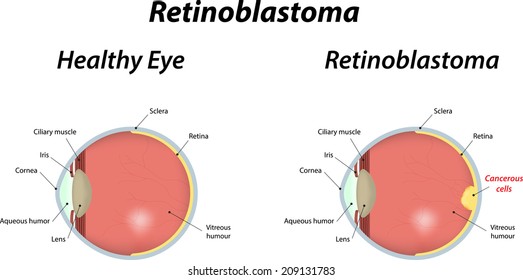 Retinoblastoma