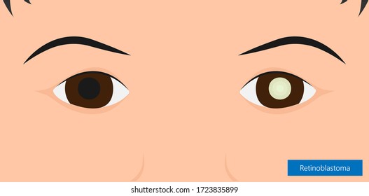 Retinoblastoma blind ophthalmologist retinocytoma ophthalmology anatomy cornea squint